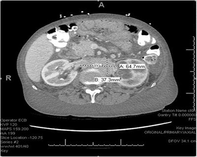 Case Report: Neuroendocrine Tumor With Cardiac Metastasis